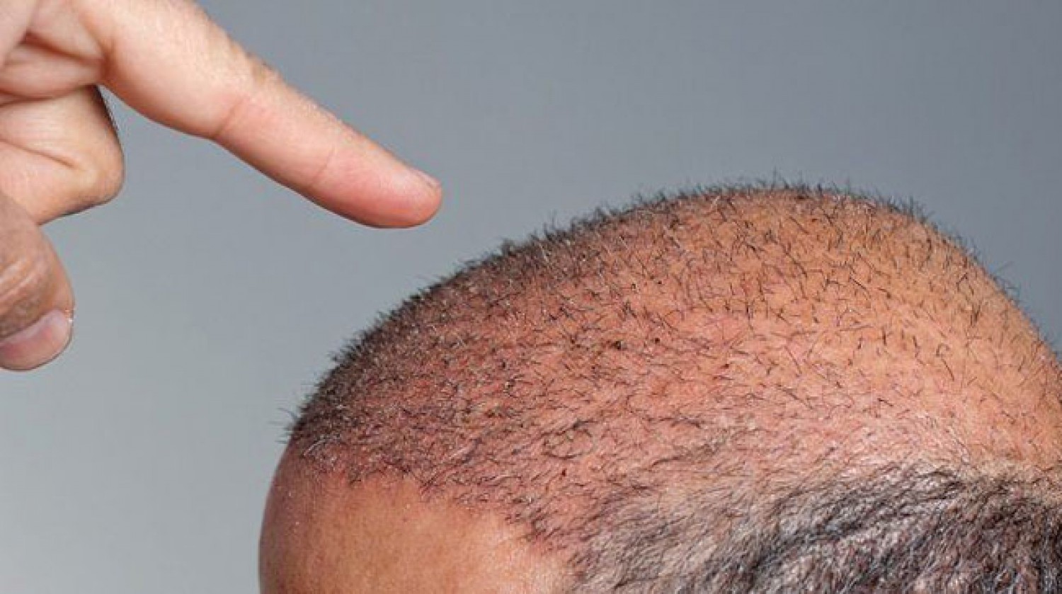 Photo of الأسباب التي تجعلك مرشحًا لإجراء عملية زراعة الشعر