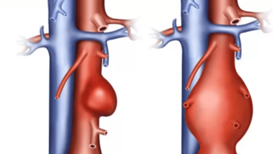 Photo of استشاري: التضخم قد يحدث في أي جزء من الشريان